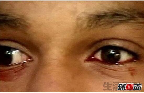 超恐怖泪血症
