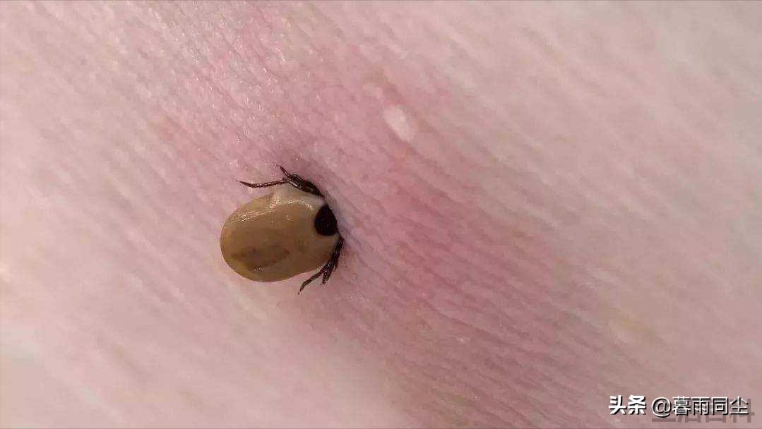 蜱虫最怕3个克星