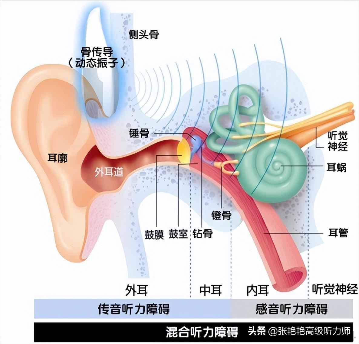 老人有必要戴助听器吗