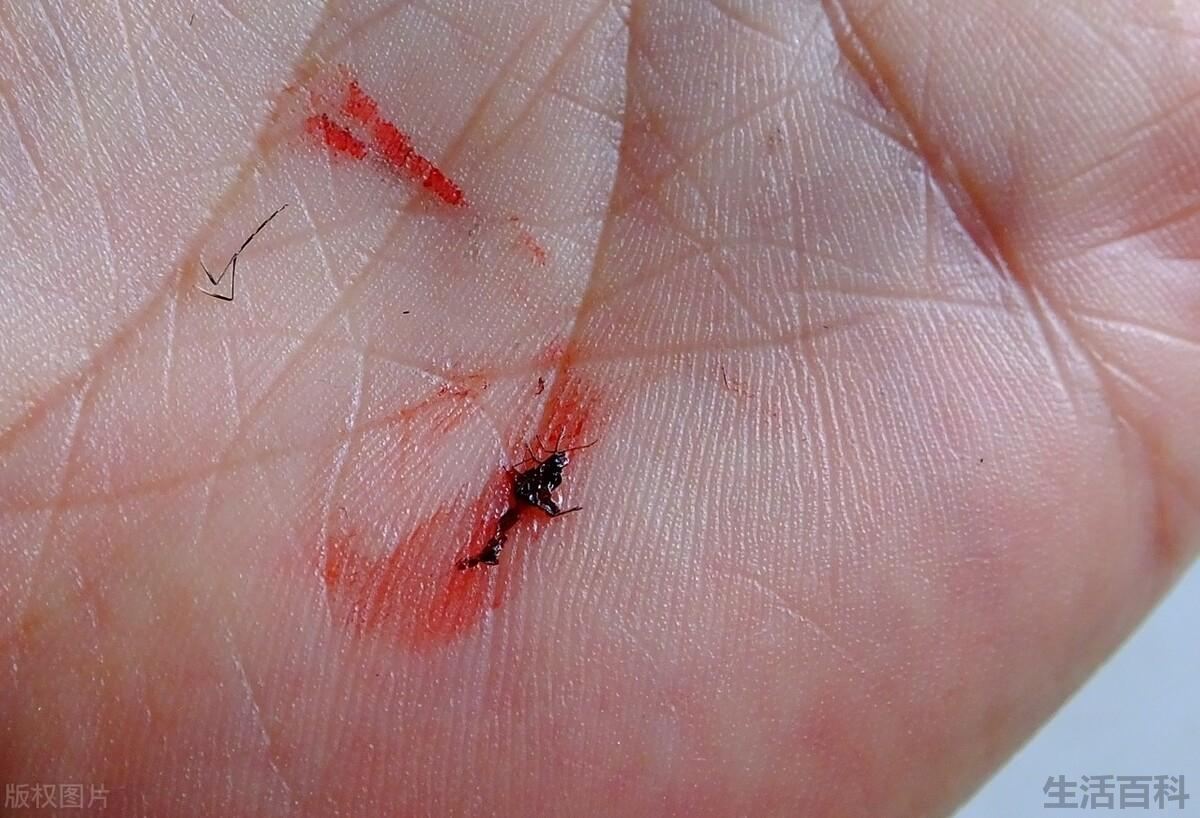 被蚊子咬了红肿痒怎么办