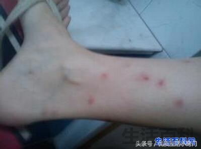 跳蚤只咬脚踝说明床上没有吗