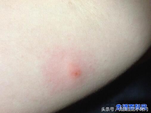 跳蚤只咬脚踝说明床上没有吗